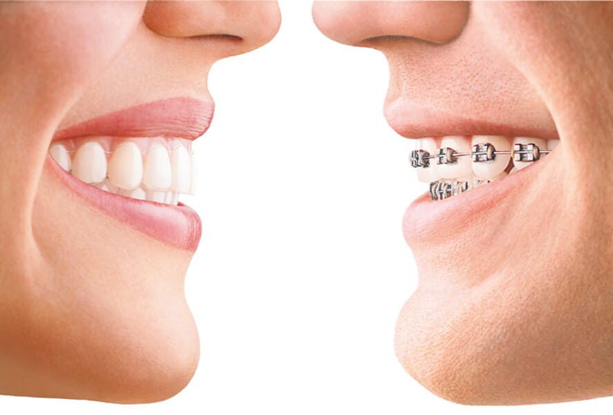 Clear-Aligners-or-Brackets-e1695275755740