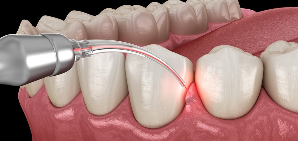 pain-free-laser-dentistry-the-dental-roots-L
